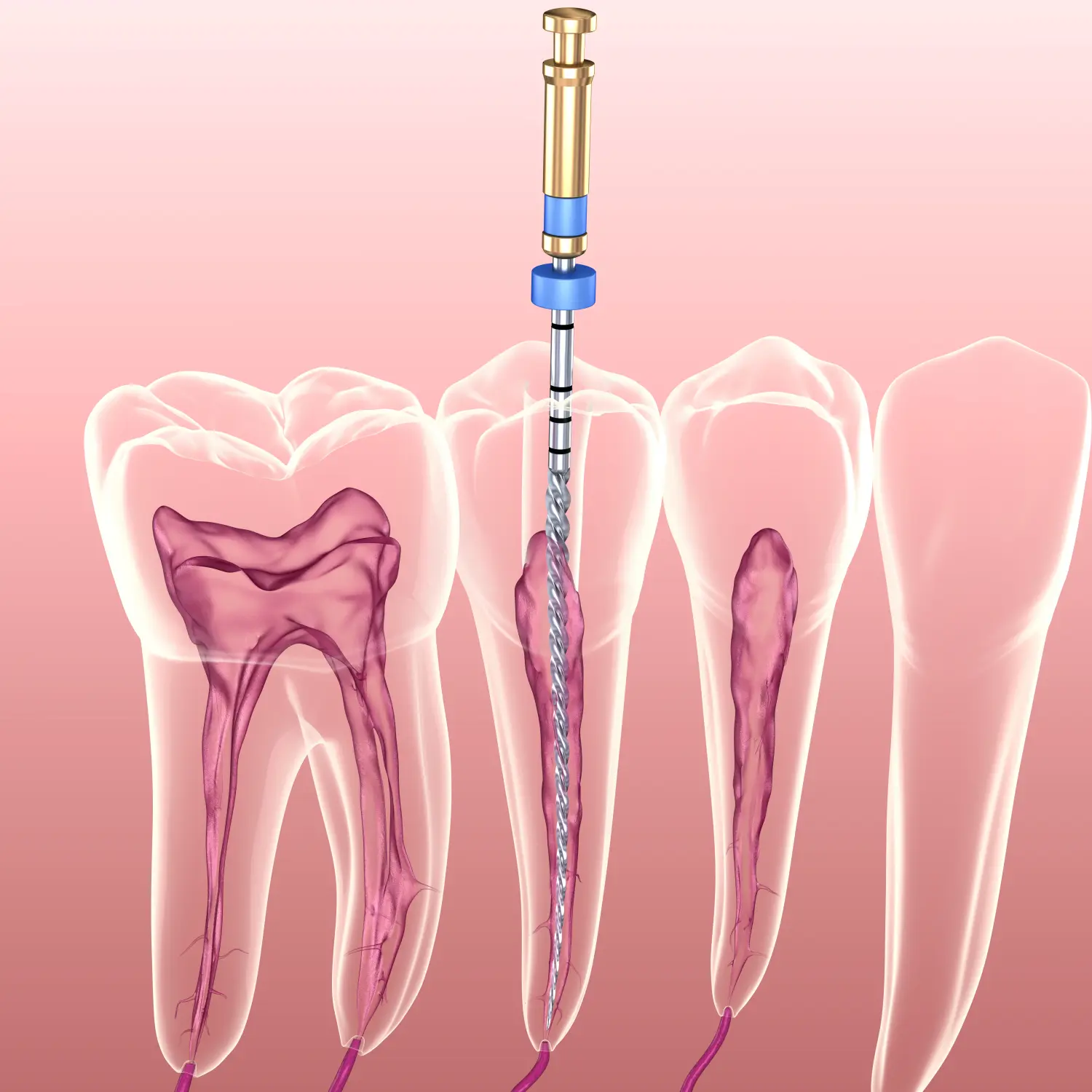 Endodontischer Wurzelkanalbehandlungsprozess. Medizinisch genaue 3D-Zahnillustration.